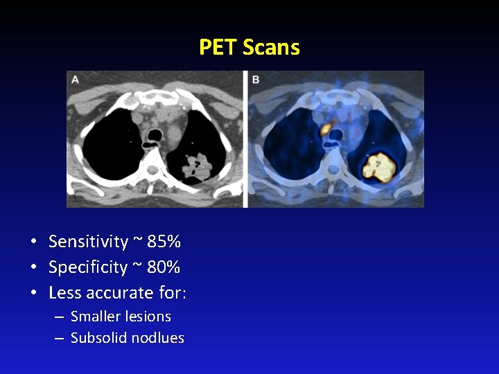 PET Scans • Sensitivity ~ 85% • Specificity ~ 80% • Less accurate for: