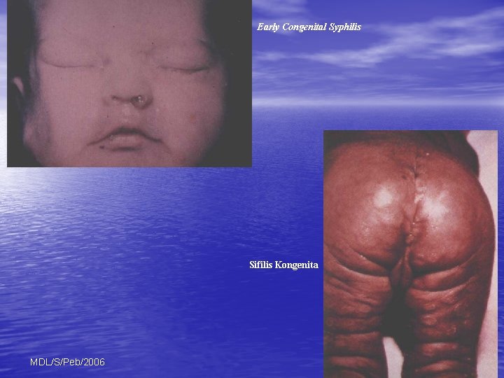 Early Congenital Syphilis Sifilis Kongenita MDL/S/Peb/2006 