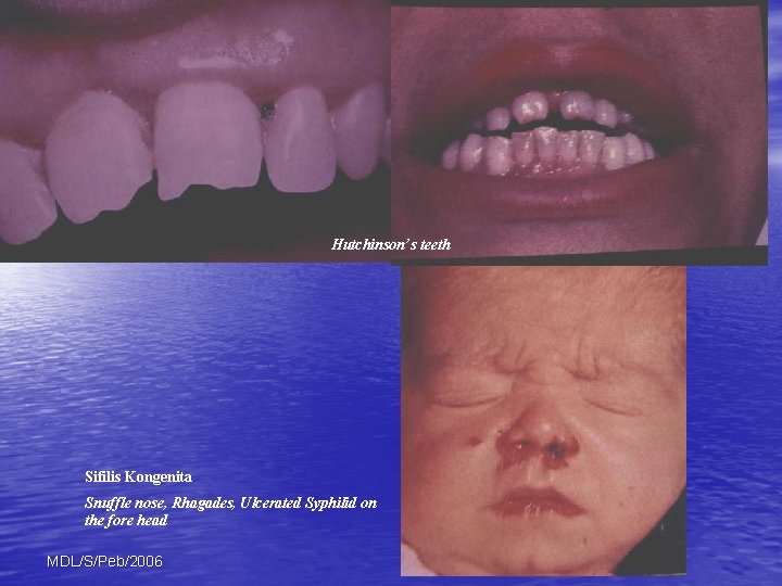 Hutchinson’s teeth Sifilis Kongenita Snuffle nose, Rhagades, Ulcerated Syphilid on the fore head MDL/S/Peb/2006
