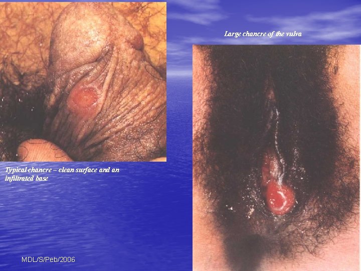 Large chancre of the vulva Typical chancre – clean surface and an infiltrated base