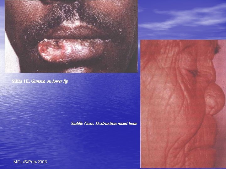 Sifilis III, Gumma on lower lip Saddle Nose, Destruction nasal bone MDL/S/Peb/2006 