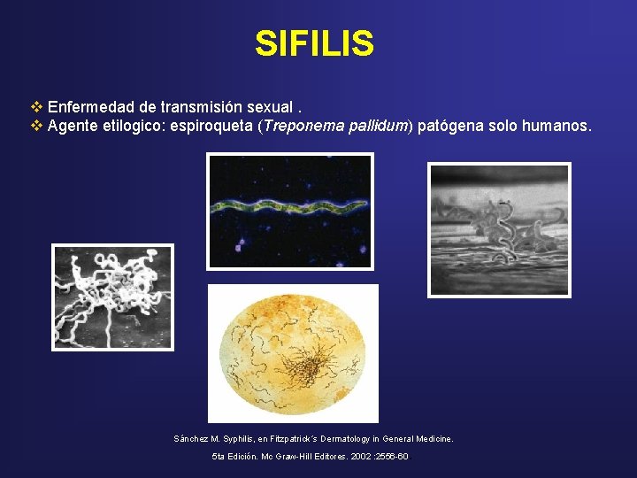 SIFILIS v Enfermedad de transmisión sexual. v Agente etilogico: espiroqueta (Treponema pallidum) patógena solo SIFILIS v Enfermedad de transmisión sexual. v Agente etilogico: espiroqueta (Treponema pallidum) patógena solo