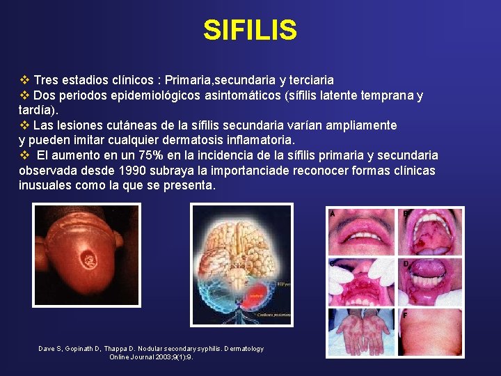 SIFILIS v Tres estadios clínicos : Primaria, secundaria y terciaria v Dos periodos epidemiológicos SIFILIS v Tres estadios clínicos : Primaria, secundaria y terciaria v Dos periodos epidemiológicos