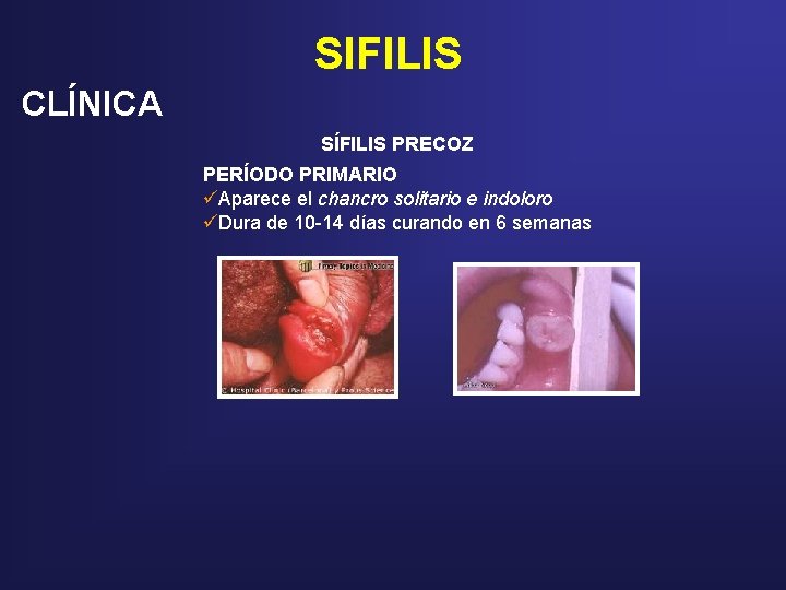 SIFILIS CLÍNICA SÍFILIS PRECOZ PERÍODO PRIMARIO üAparece el chancro solitario e indoloro üDura de SIFILIS CLÍNICA SÍFILIS PRECOZ PERÍODO PRIMARIO üAparece el chancro solitario e indoloro üDura de