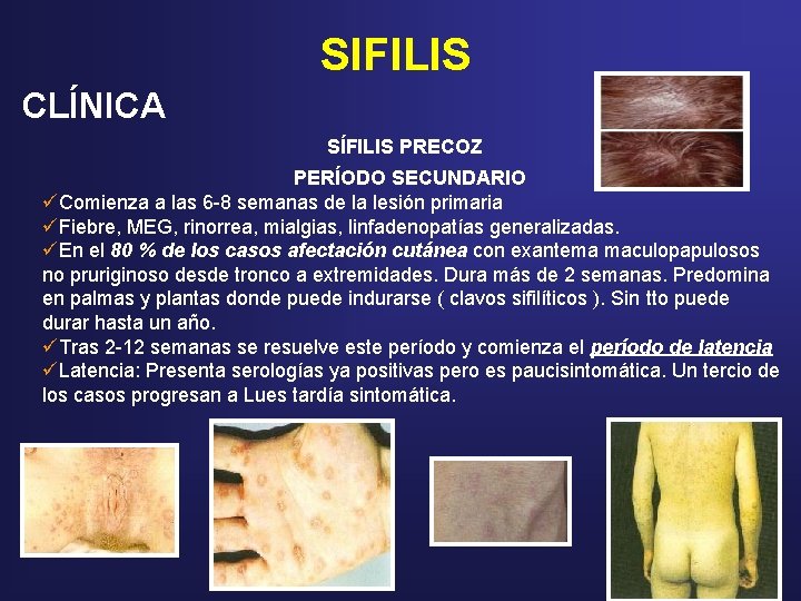 SIFILIS CLÍNICA SÍFILIS PRECOZ PERÍODO SECUNDARIO üComienza a las 6 -8 semanas de la SIFILIS CLÍNICA SÍFILIS PRECOZ PERÍODO SECUNDARIO üComienza a las 6 -8 semanas de la