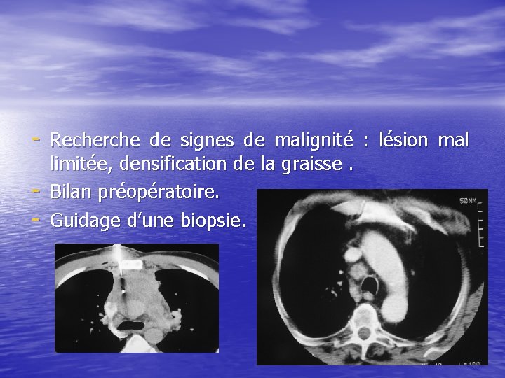 - Recherche de signes de malignité : lésion mal - limitée, densification de la