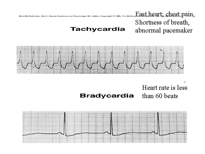 Fast heart; chest pain, Shortness of breath, abnormal pacemaker Heart rate is less than