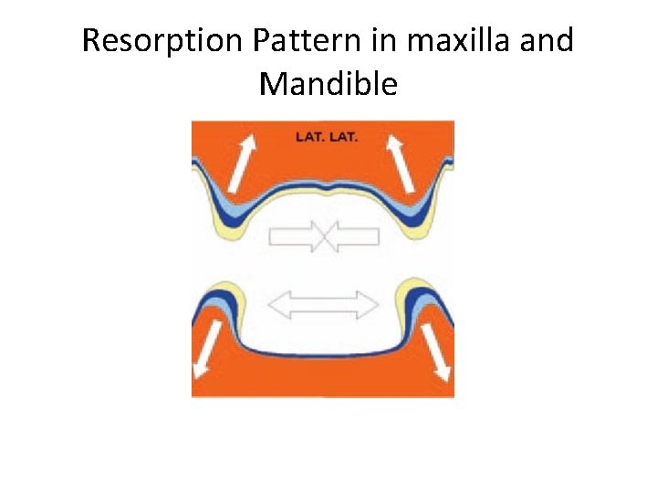 Resorption Pattern in maxilla and Mandible 