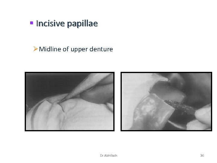 § Incisive papillae ØMidline of upper denture Dr Abhilash 36 