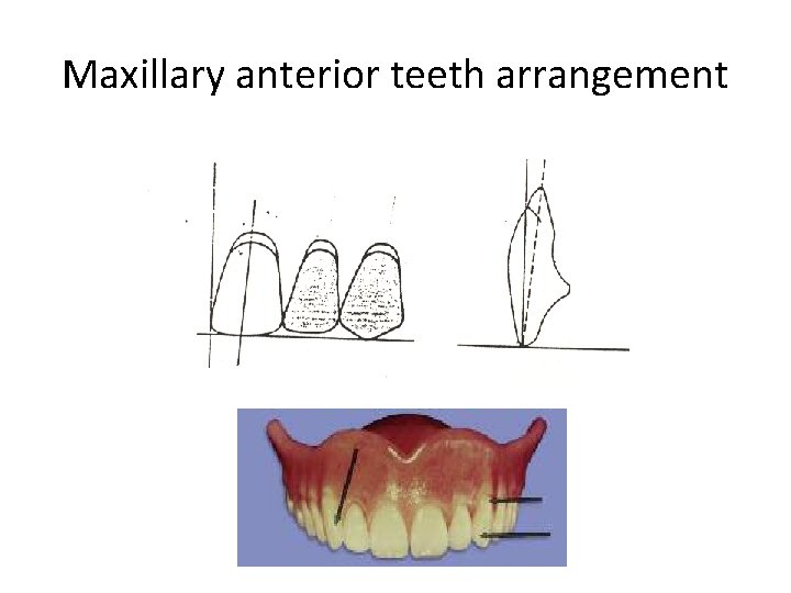 Maxillary anterior teeth arrangement 