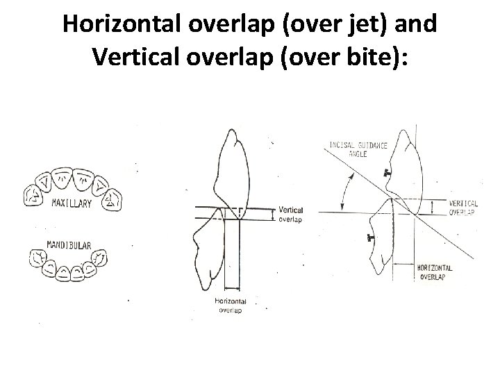 Horizontal overlap (over jet) and Vertical overlap (over bite): 