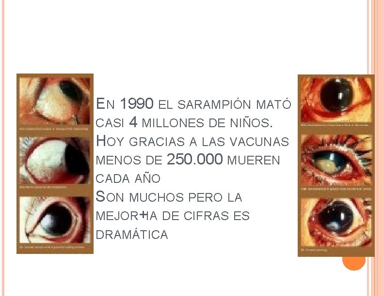 EN 1990 EL SARAMPIÓN MATÓ CASI 4 MILLONES DE NIÑOS. HOY GRACIAS A LAS