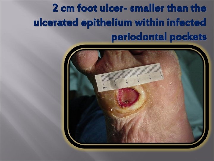 2 cm foot ulcer- smaller than the ulcerated epithelium within infected periodontal pockets 