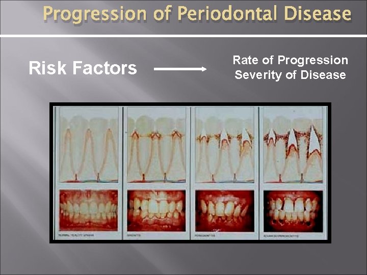 Progression of Periodontal Disease Risk Factors Rate of Progression Severity of Disease 