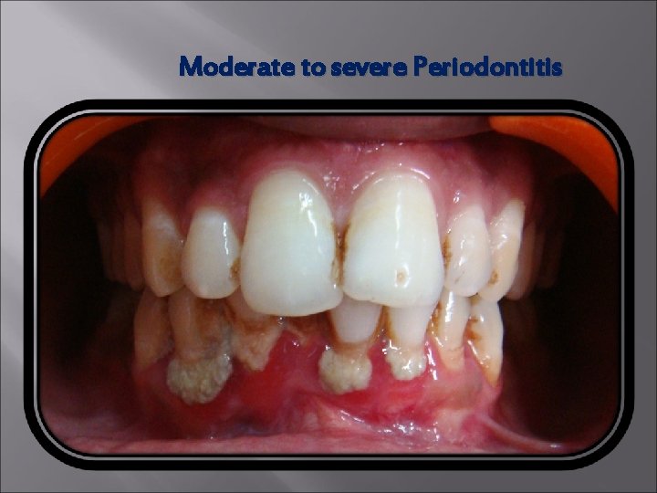 Moderate to severe Periodontitis 