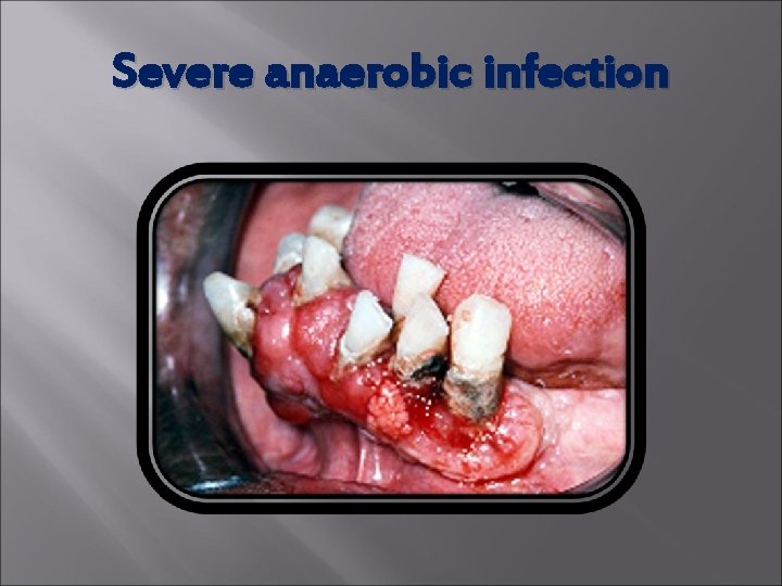 Severe anaerobic infection 