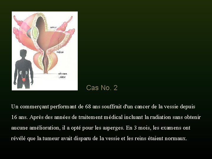 Cas No. 2 Un commerçant performant de 68 ans souffrait d'un cancer de la Cas No. 2 Un commerçant performant de 68 ans souffrait d'un cancer de la