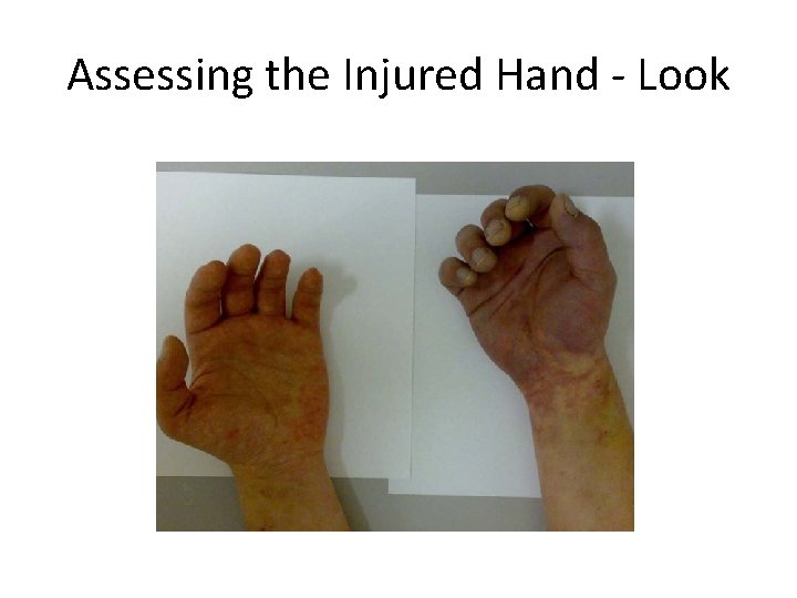 Assessing the Injured Hand - Look 