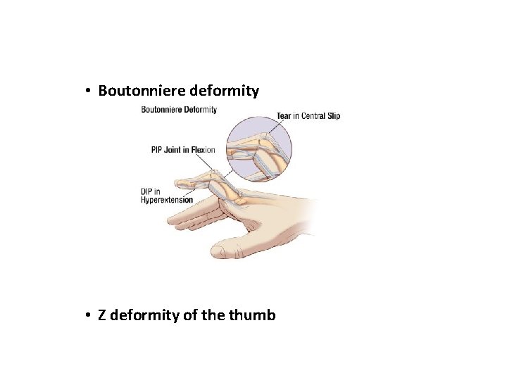  • Boutonniere deformity • Z deformity of the thumb 