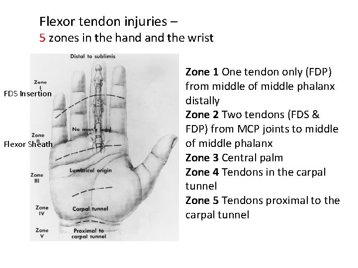 Flexor tendon injuries – 5 zones in the hand the wrist FDS Insertion Flexor