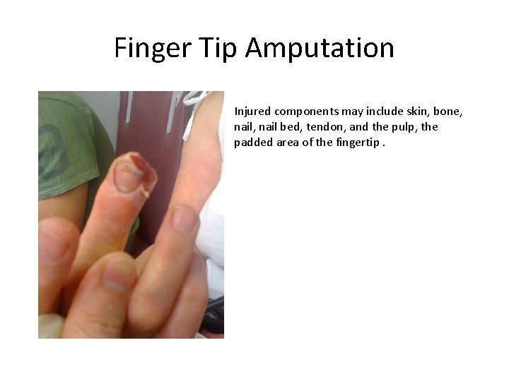 Finger Tip Amputation Injured components may include skin, bone, nail, nail bed, tendon, and