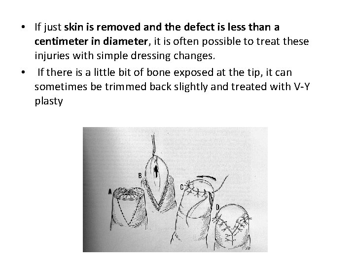  • If just skin is removed and the defect is less than a