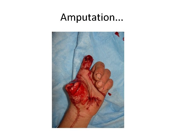 Amputation. . . 