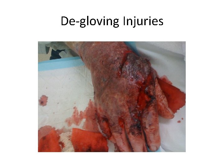 De-gloving Injuries 