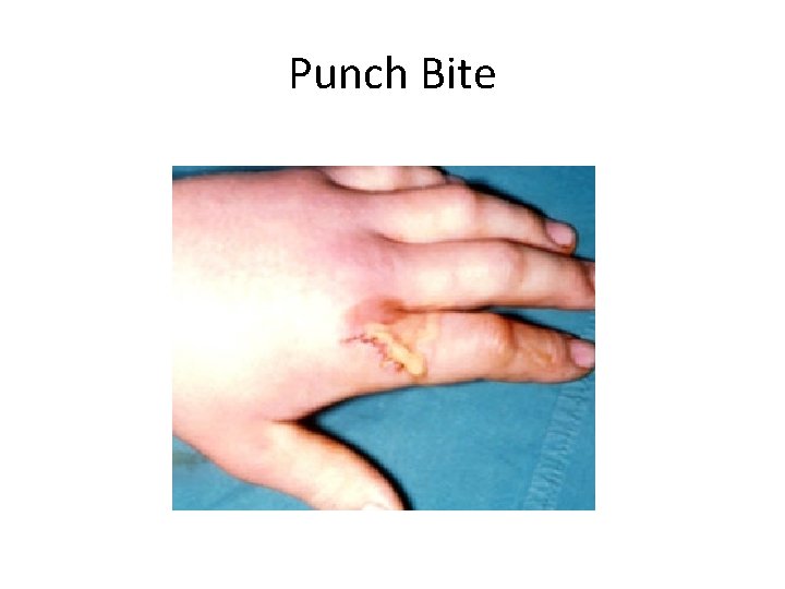 Punch Bite 