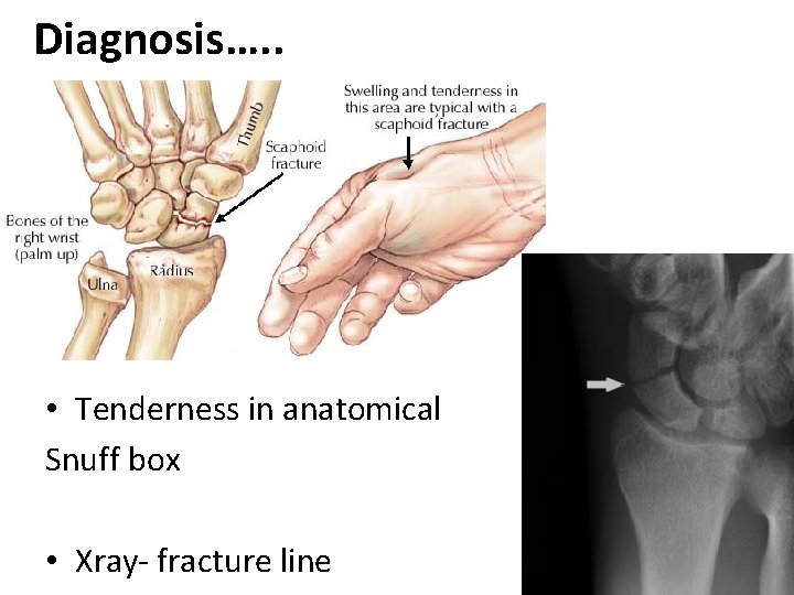 Diagnosis…. . • Tenderness in anatomical Snuff box • Xray- fracture line 