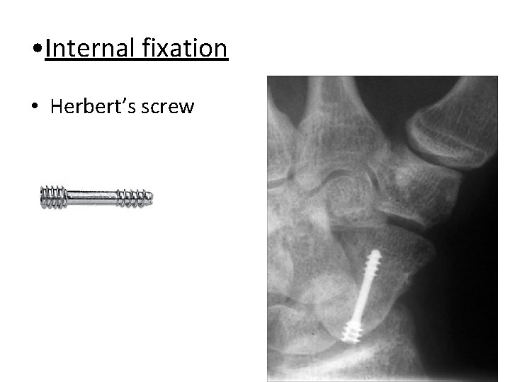  • Internal fixation • Herbert’s screw 