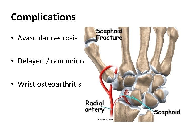 Complications • Avascular necrosis • Delayed / non union • Wrist osteoarthritis 