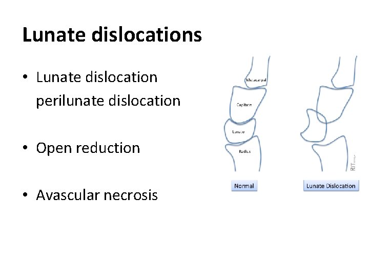 Lunate dislocations • Lunate dislocation perilunate dislocation • Open reduction • Avascular necrosis 