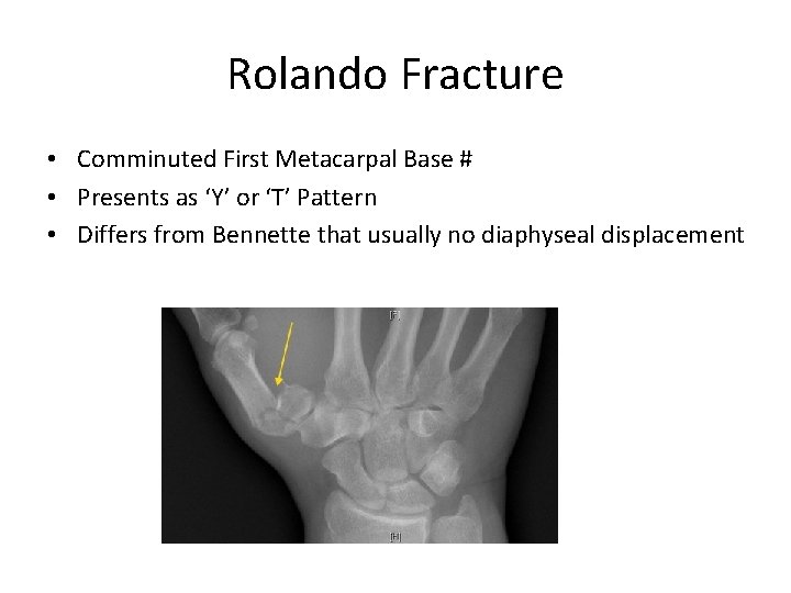 Rolando Fracture • Comminuted First Metacarpal Base # • Presents as ‘Y’ or ‘T’