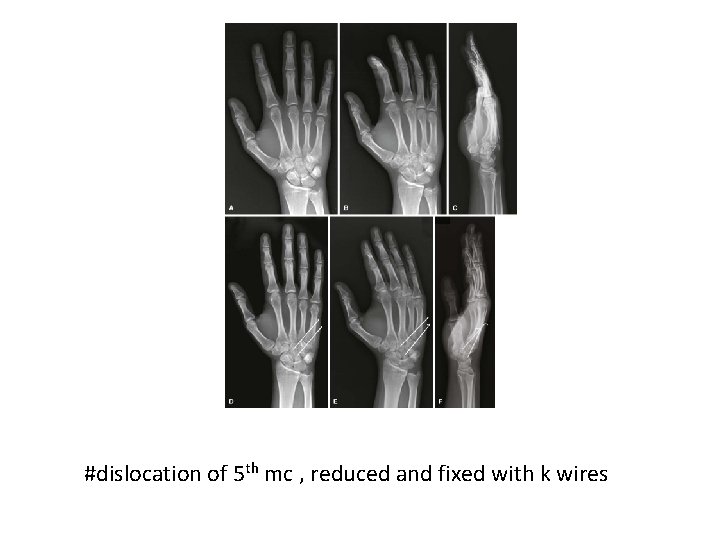 #dislocation of 5 th mc , reduced and fixed with k wires 