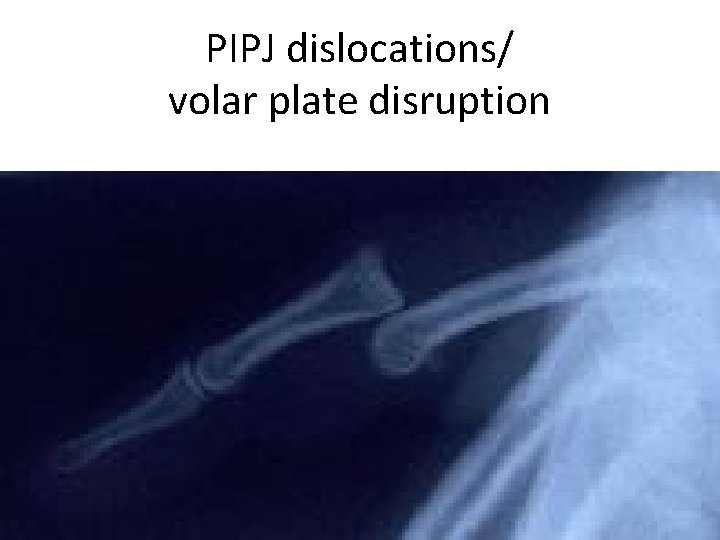 PIPJ dislocations/ volar plate disruption 