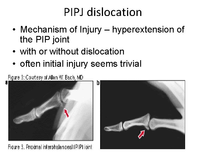 PIPJ dislocation • Mechanism of Injury – hyperextension of the PIP joint • with