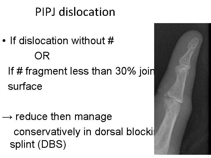  PIPJ dislocation • If dislocation without # OR If # fragment less than