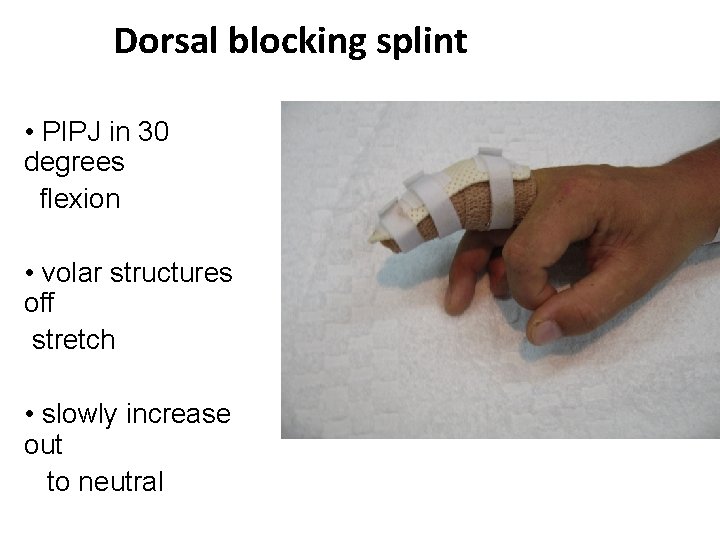 Dorsal blocking splint • PIPJ in 30 degrees flexion • volar structures off stretch