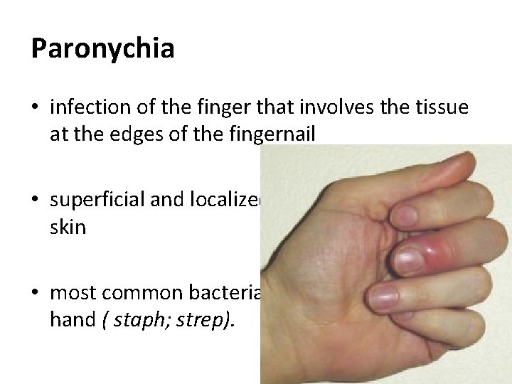 Paronychia • infection of the finger that involves the tissue at the edges of