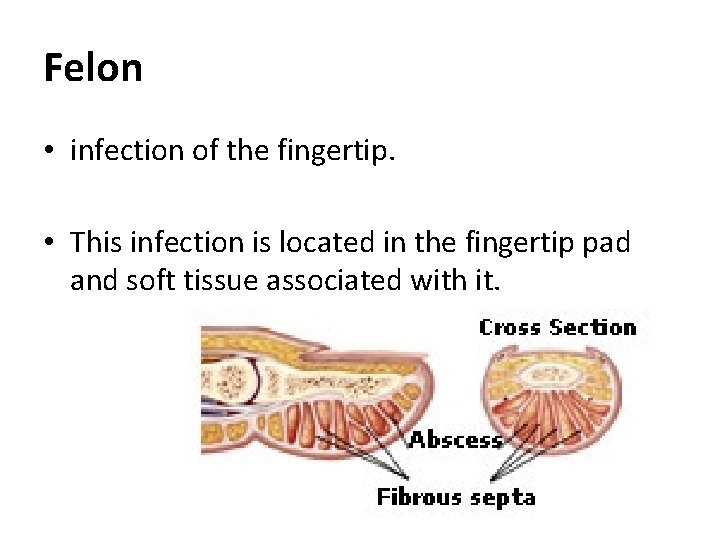 Felon • infection of the fingertip. • This infection is located in the fingertip