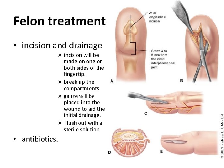 Felon treatment • incision and drainage » incision will be made on one or