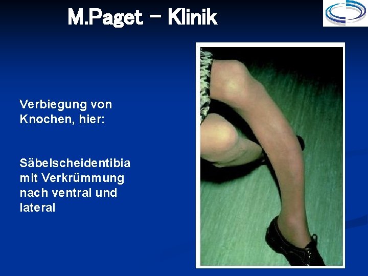 M. Paget - Klinik Verbiegung von Knochen, hier: Säbelscheidentibia mit Verkrümmung nach ventral und