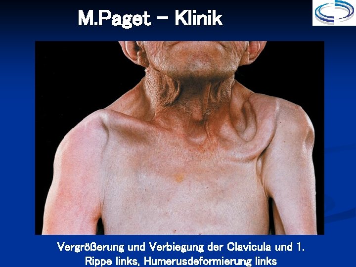 M. Paget - Klinik Vergrößerung und Verbiegung der Clavicula und 1. Rippe links, Humerusdeformierung