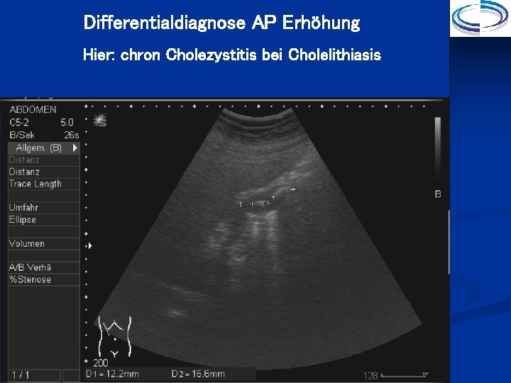 Differentialdiagnose AP Erhöhung Hier: chron Cholezystitis bei Cholelithiasis 