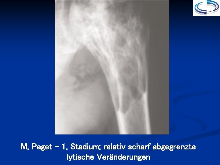 M. Paget – 1. Stadium: relativ scharf abgegrenzte lytische Veränderungen 