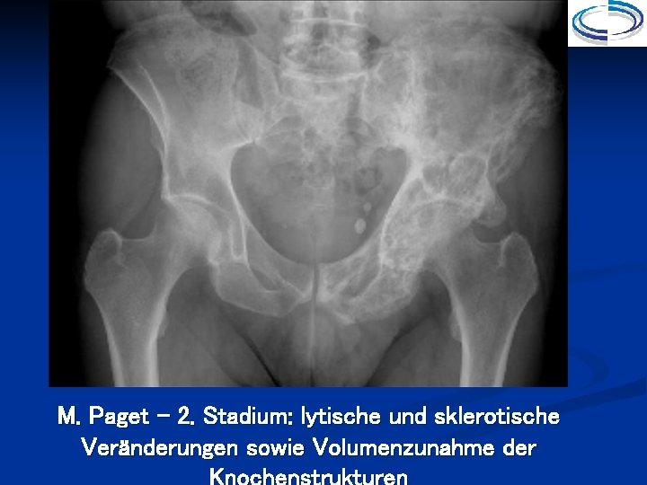 M. Paget – 2. Stadium: lytische und sklerotische Veränderungen sowie Volumenzunahme der 