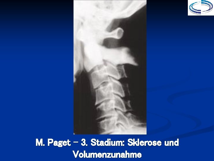 M. Paget - 3. Stadium: Sklerose und Volumenzunahme 