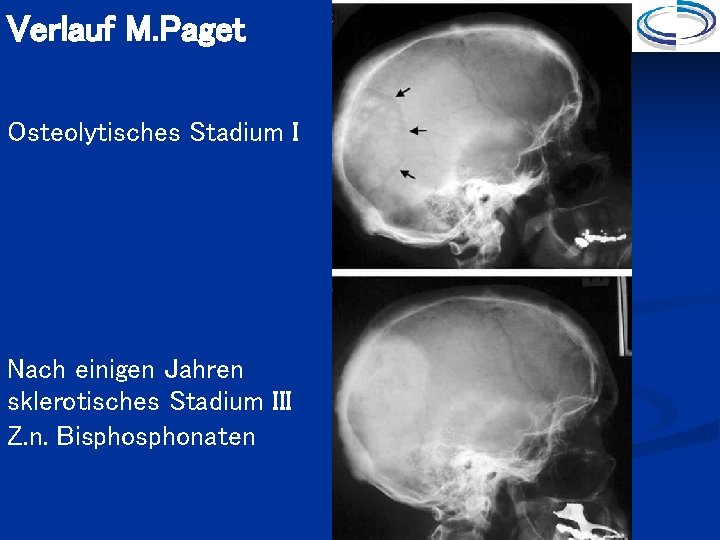 Verlauf M. Paget Osteolytisches Stadium I Nach einigen Jahren sklerotisches Stadium III Z. n.