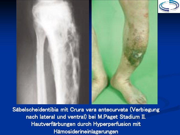 Säbelscheidentibia mit Crura vara antecurvata (Verbiegung nach lateral und ventral) bei M. Paget Stadium